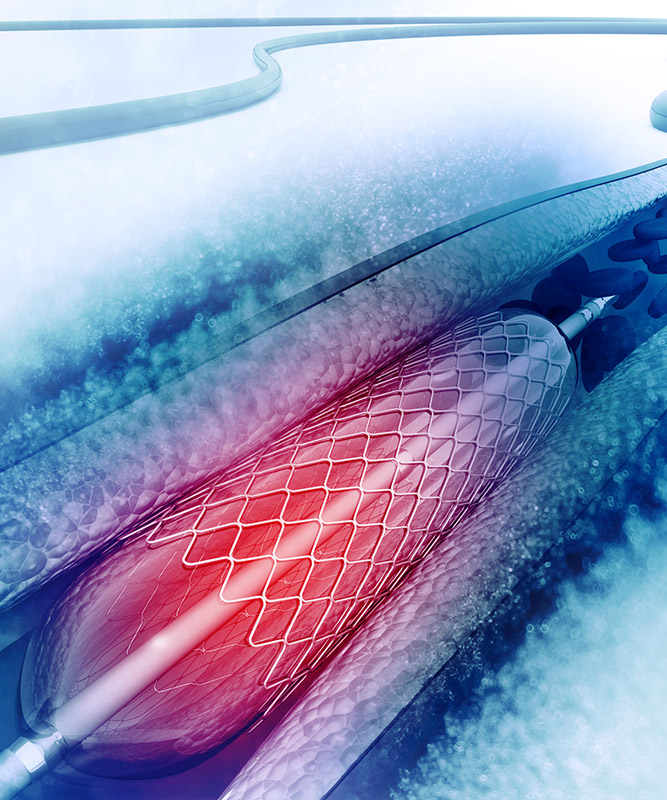 stent